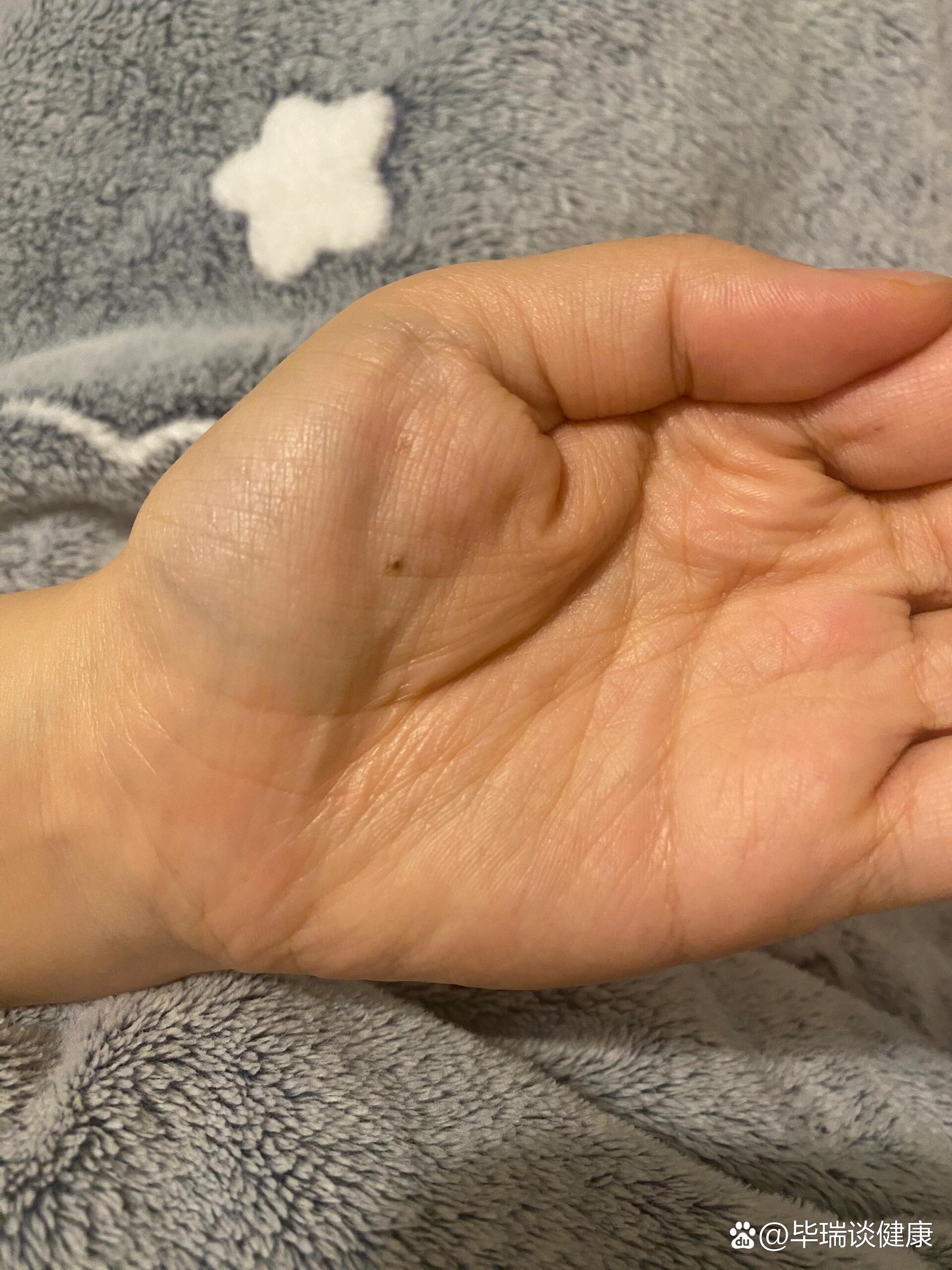 没有肌肉跳动可以排除渐冻症吗