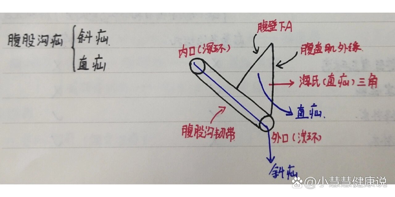 斜疝与直疝的鉴别表格图片