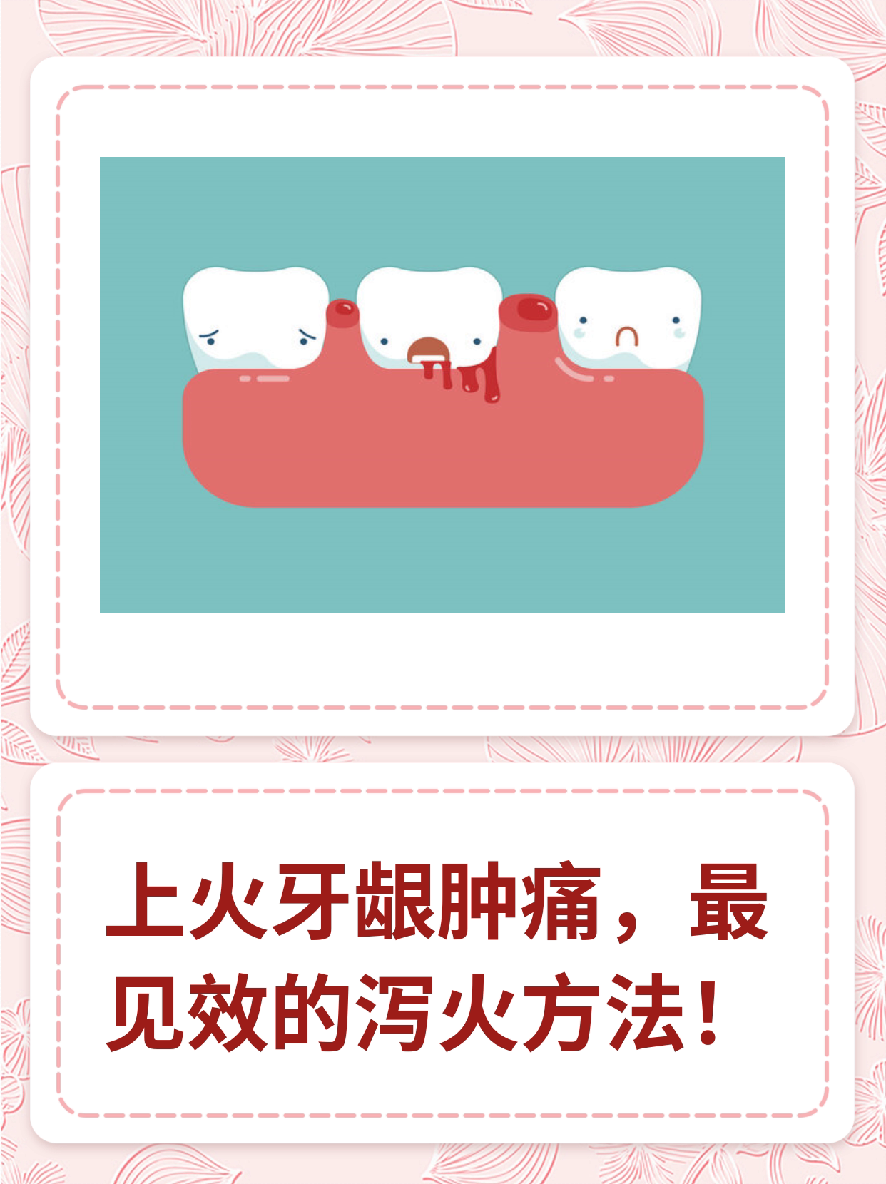 上火牙龈肿痛,最见效的泻火方法