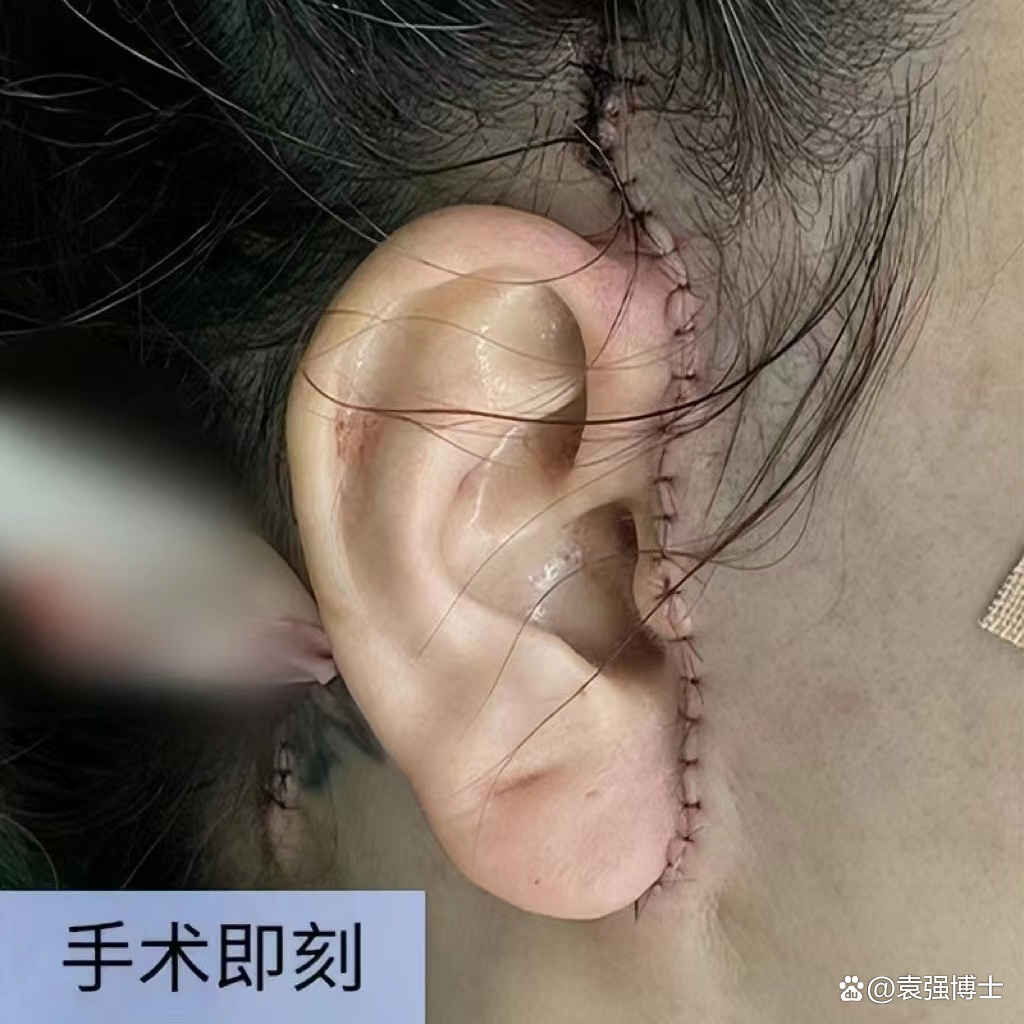 拉皮手术后切口恢复展示,10天,27天,120天,每个阶段大不相同