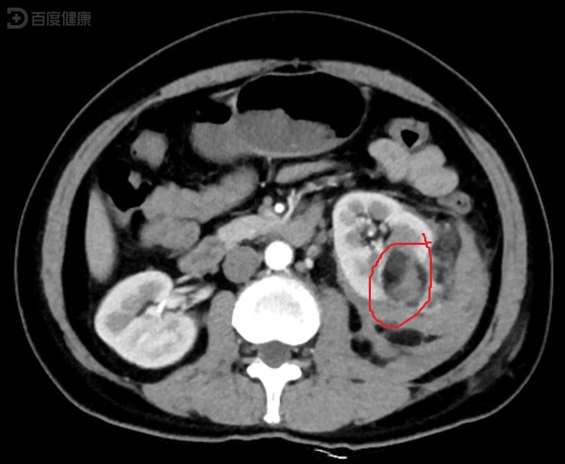 左肾错构瘤图片