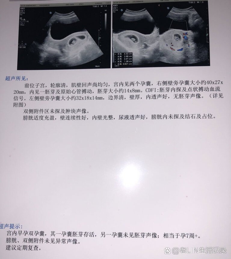 多胎妊娠的7大危害,希望男士认真看😭