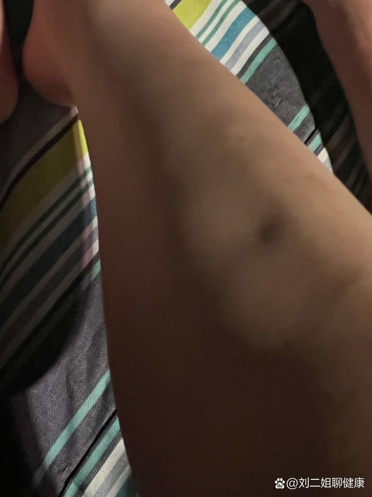  p>小腿上有个凹下去的坑 br>小腿前面的骨头有个凹洞,今天突然发现的