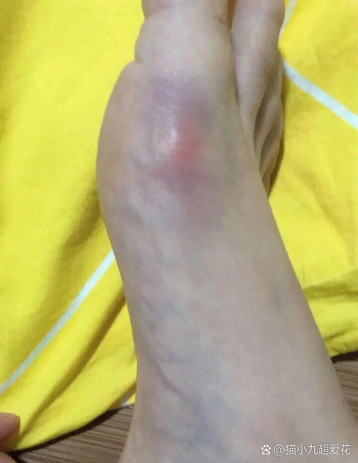 因为痛风发作肿成这个样子