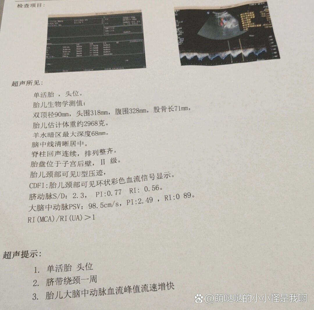 胎儿大脑中动脉血流峰值流速增快