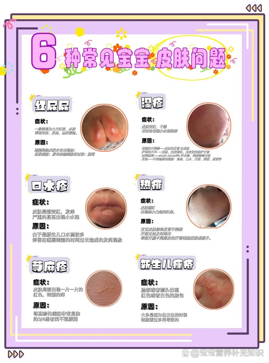 6种多发新生儿皮肤问题