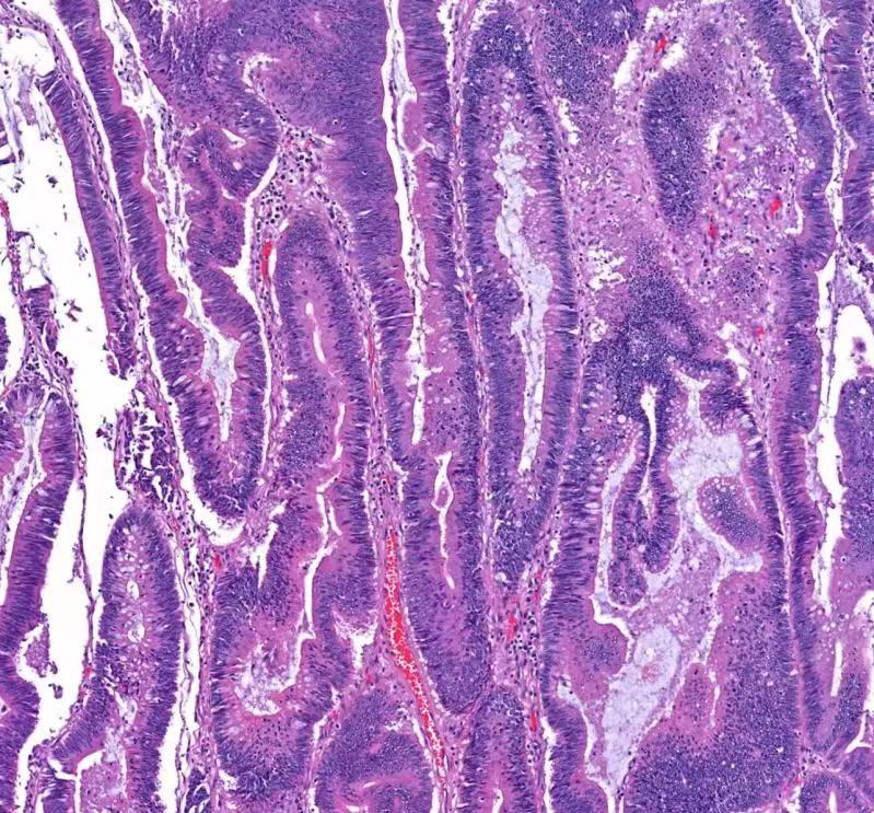 绒毛状腺瘤早发现,早治疗