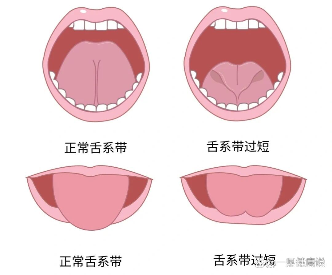 正常颊系带的位置图片图片