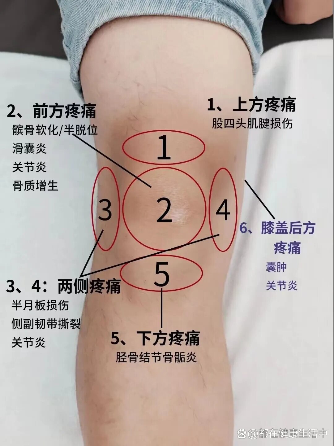 一图看懂膝关节疼痛的不同位置