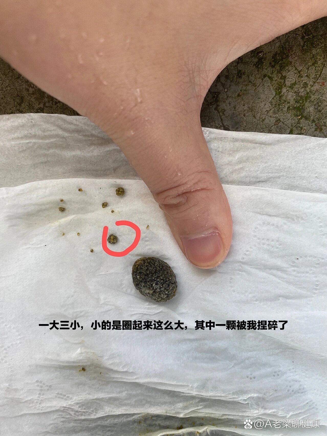 多发性胆囊结石伴胆囊炎1