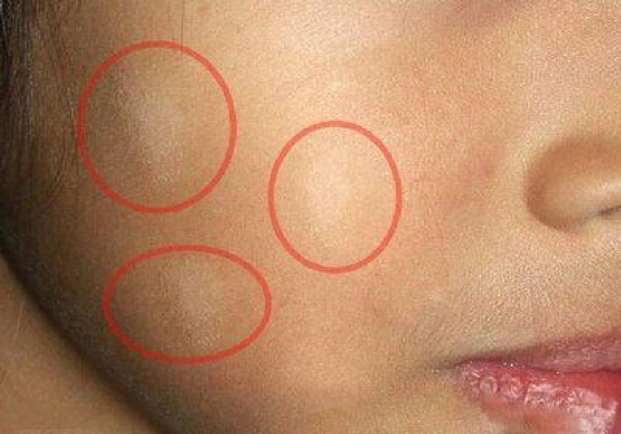 "孩子怕是肚子里有虫吧",其实不是,西医叫它"糠疹",中医叫它"积食斑"