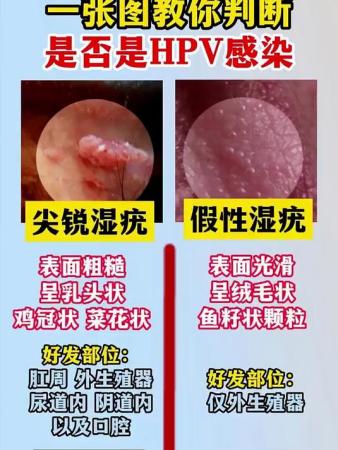 一张图辨尖锐湿疣真假