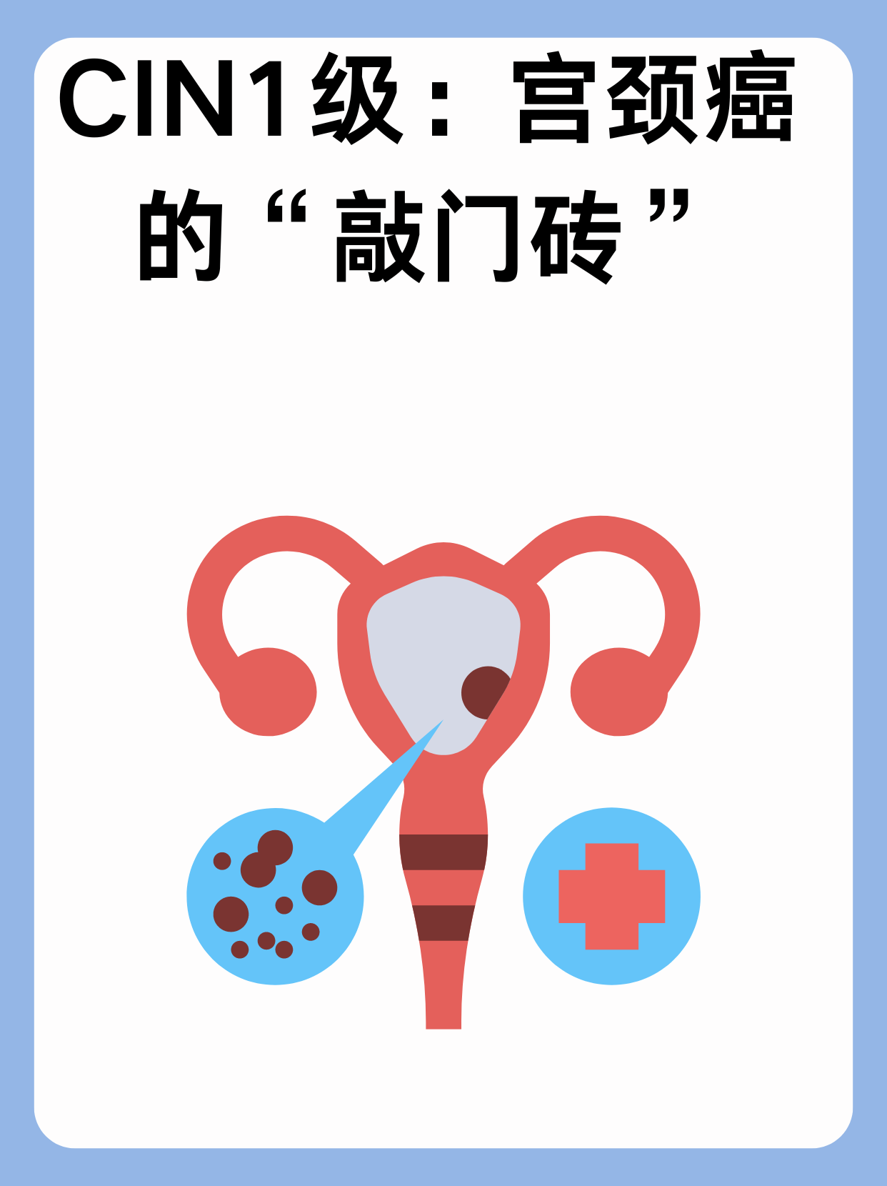 宫颈上皮内肿瘤1级:癌前病变的早期信号