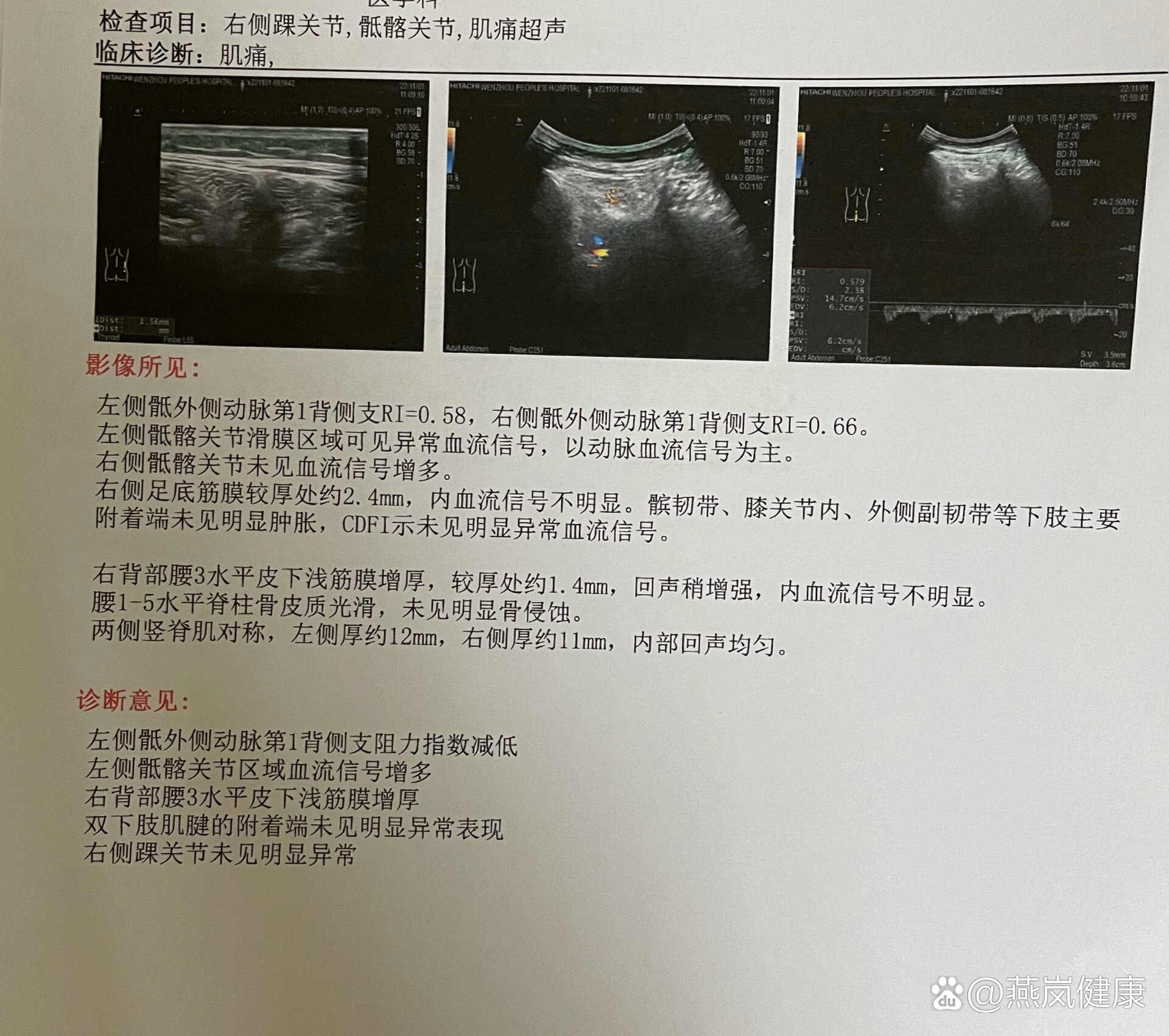 骨化性肌炎超声图片图片