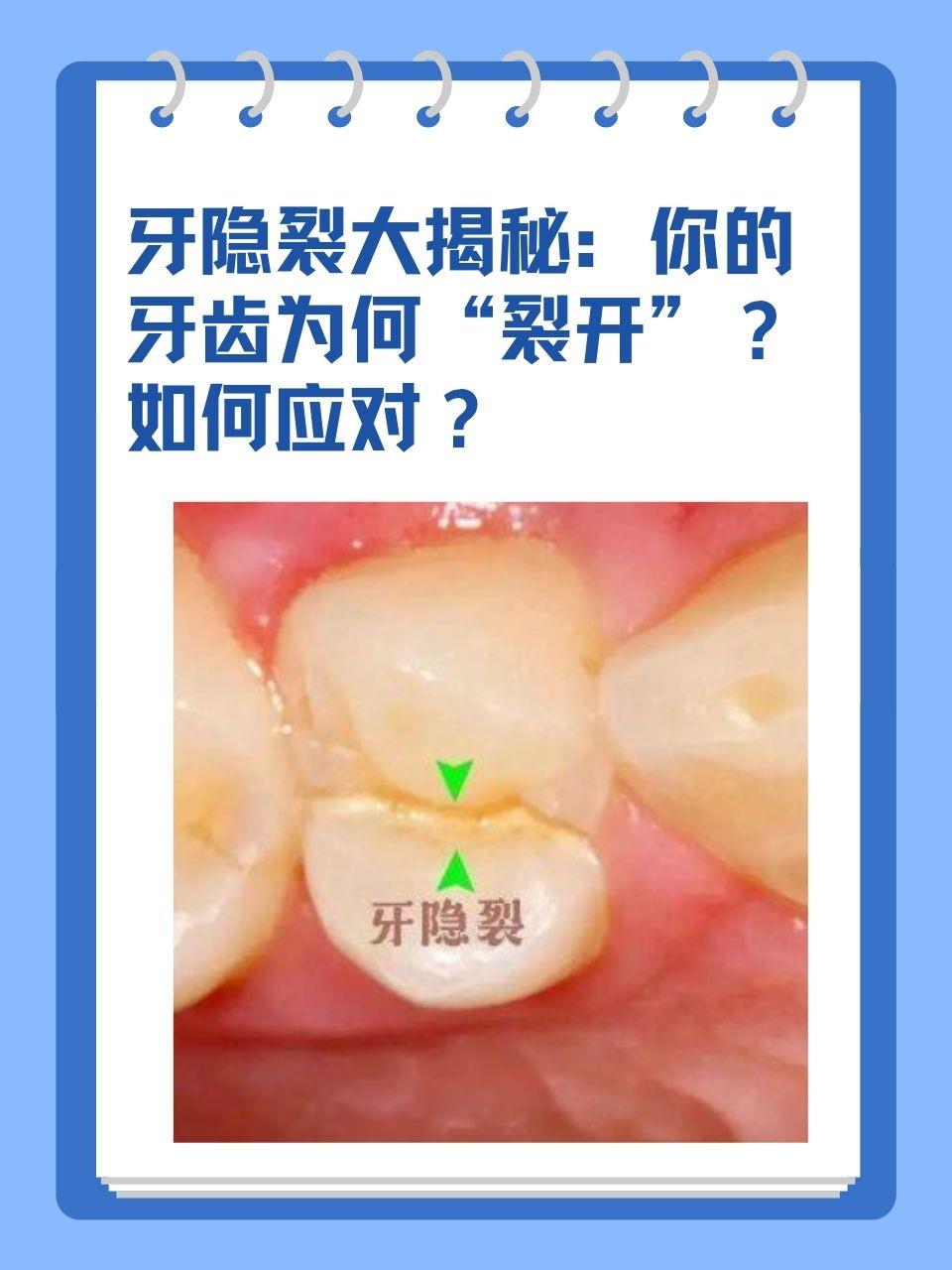 臼齿侧面裂缝图片