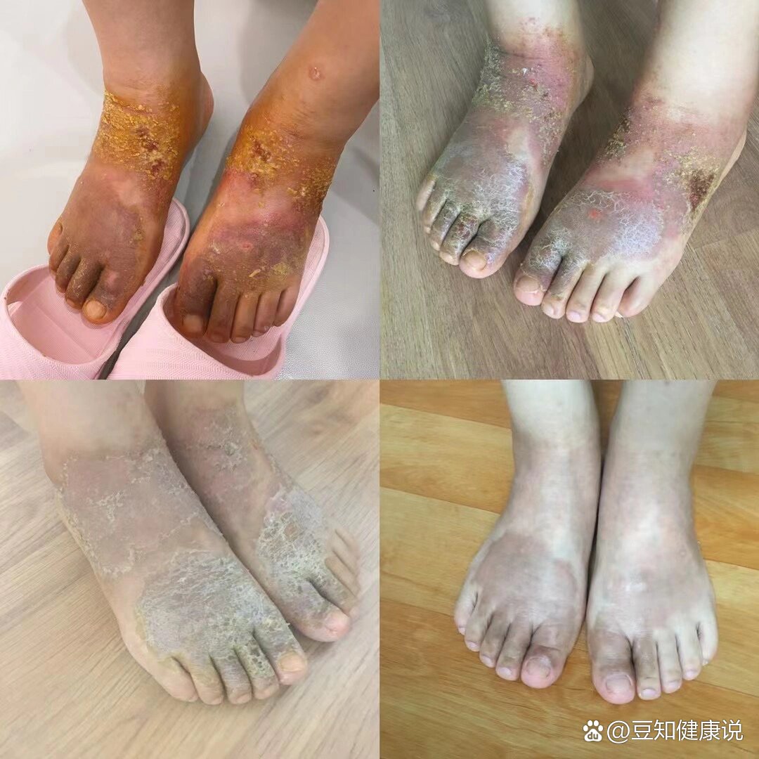 足部疱疹
