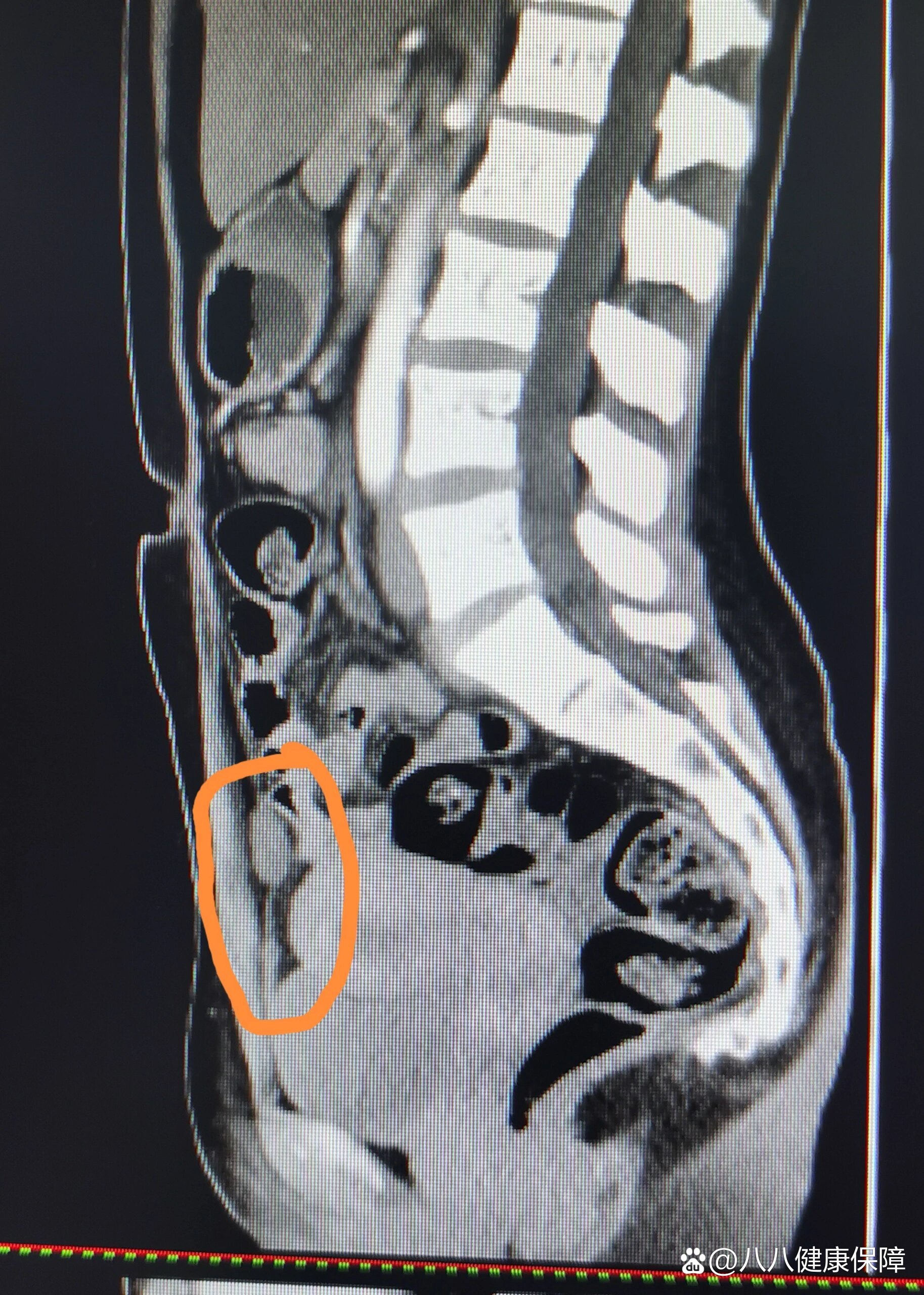 啥是脐尿管囊肿?