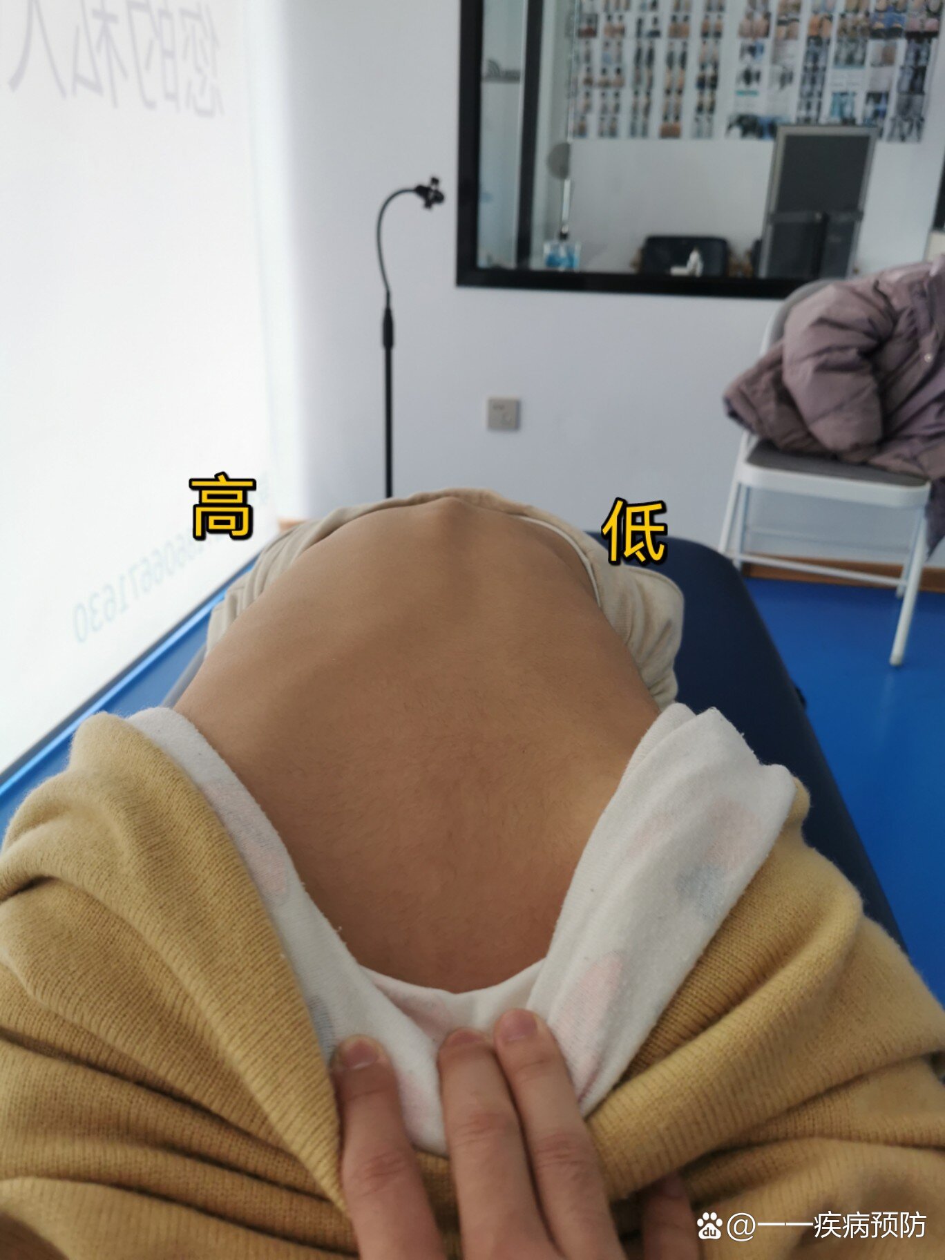 脊柱侧弯的前期症状