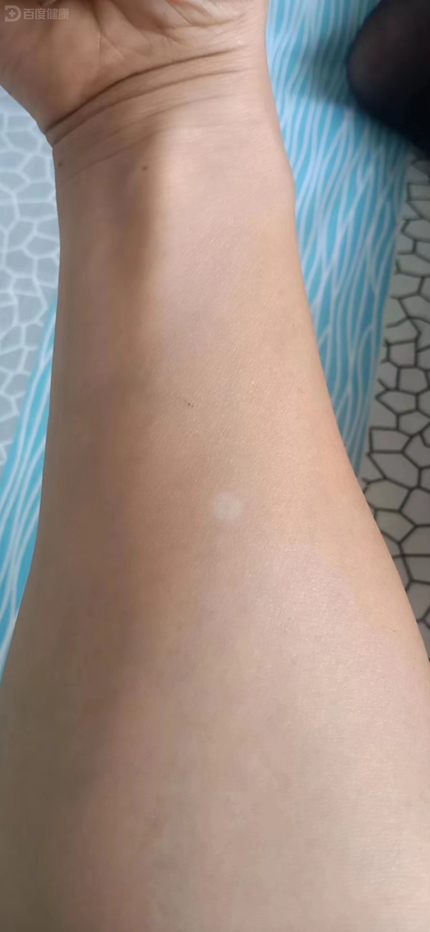 21岁男性患者出现无色素痣,外用药物改善症状