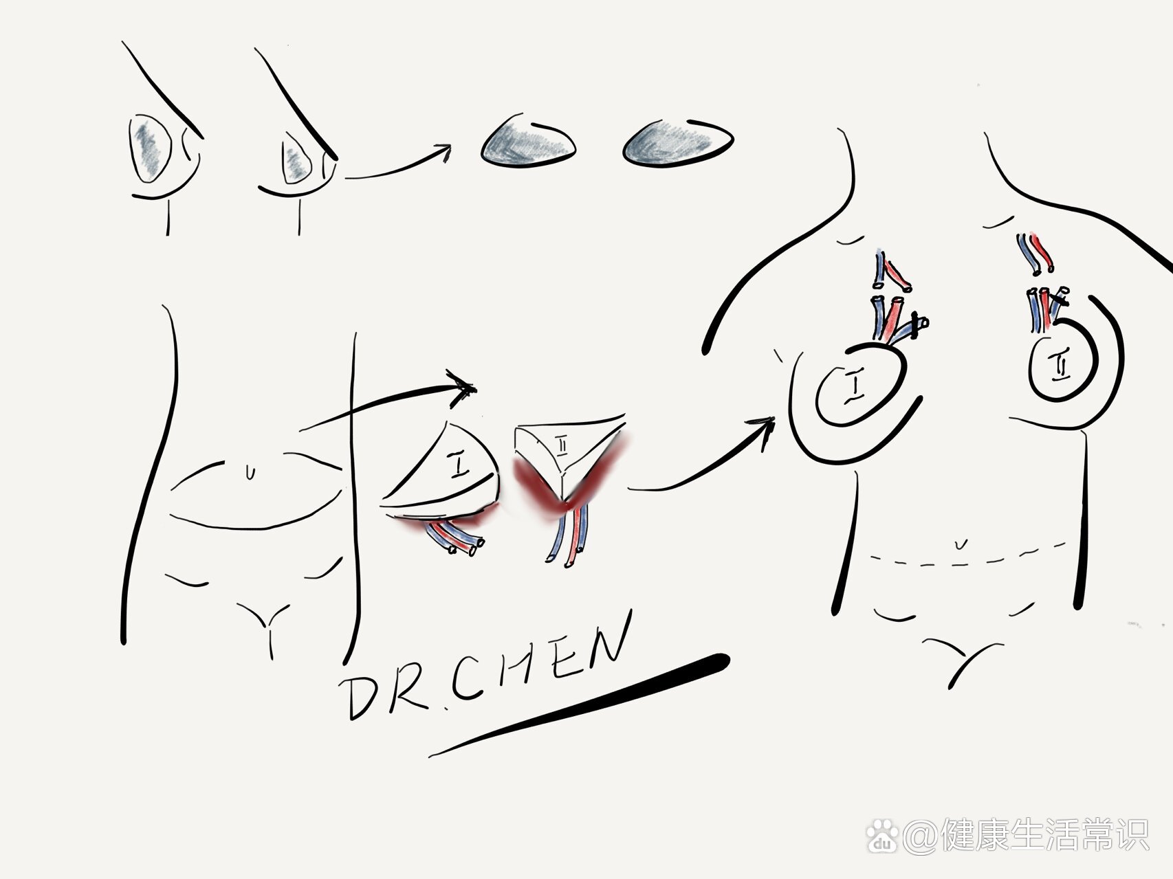 乳腺手术绘图