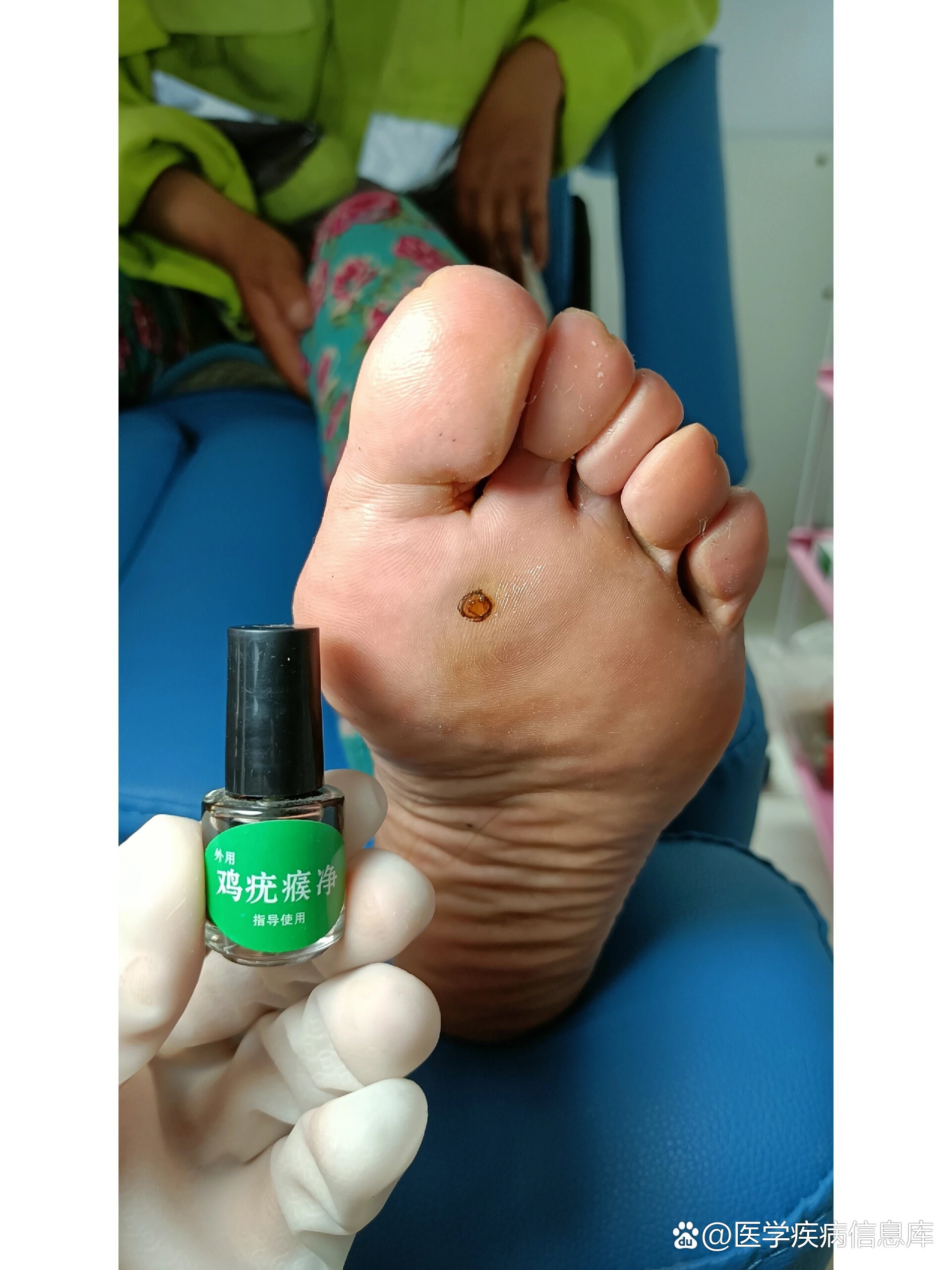 脚上长鸡眼就用它,百分百好用