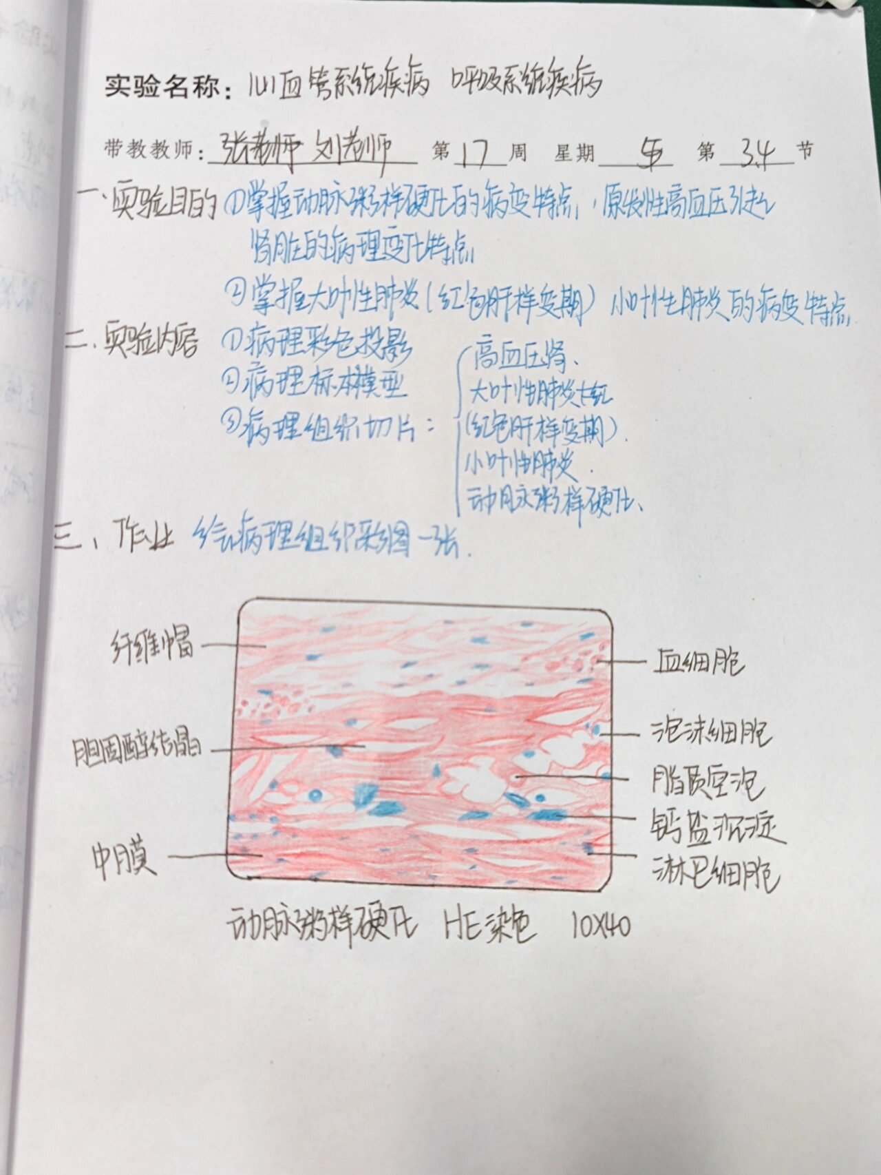 动脉粥样硬化红蓝铅笔图片