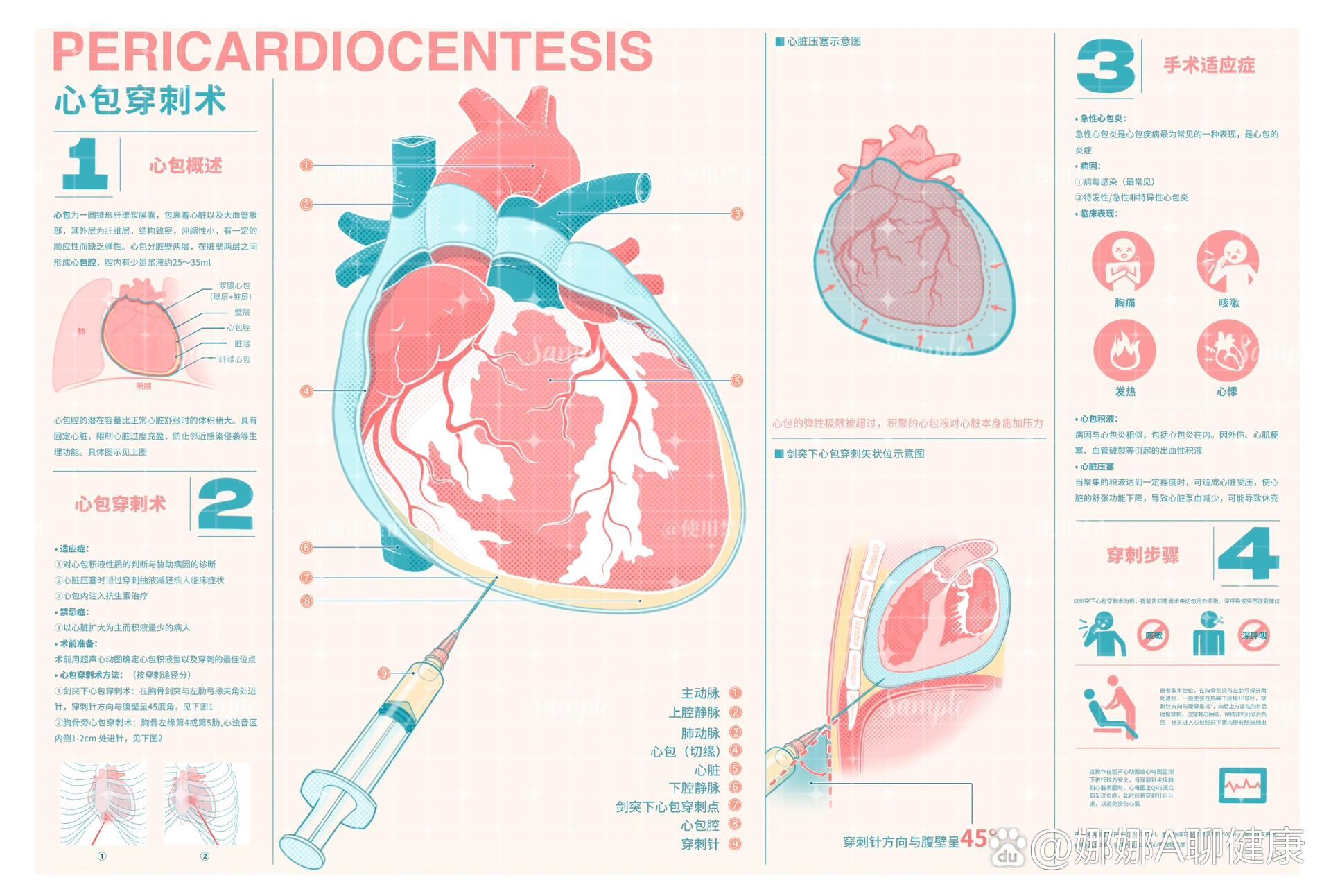 🫀心包穿刺术💉医学可视化考级