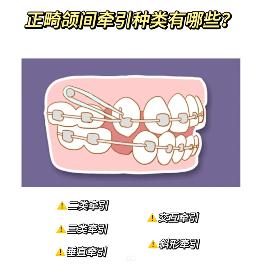 正畸垂直牵引示意图图片