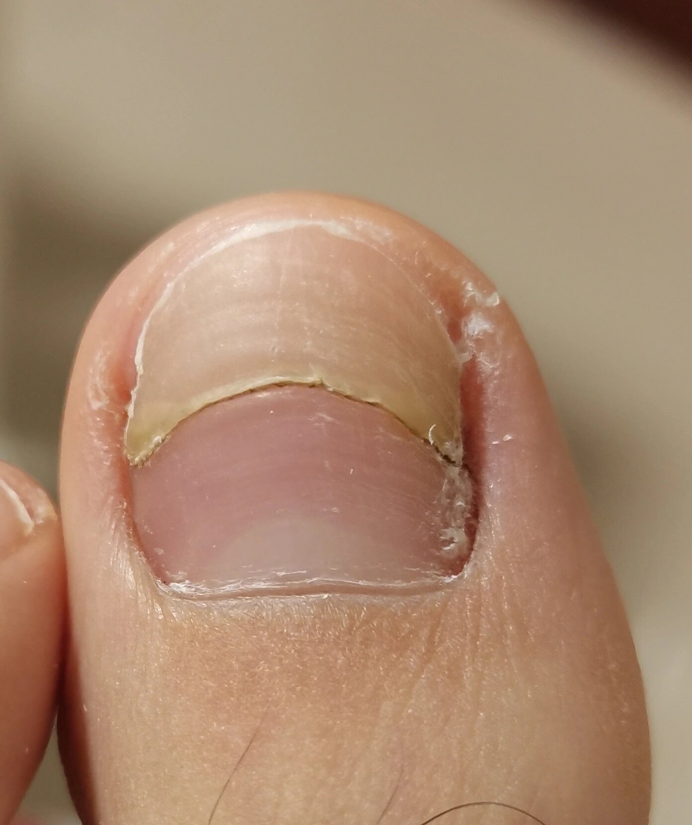 脚趾甲中间裂开