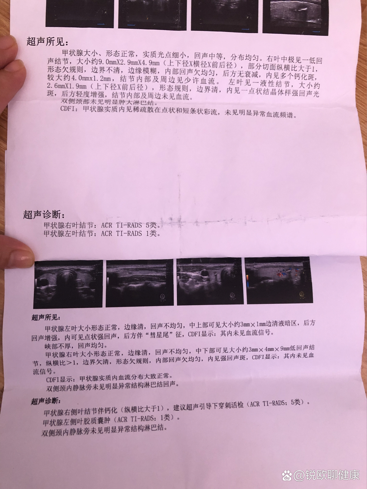 甲状腺五类结节术后病理报告:良性.