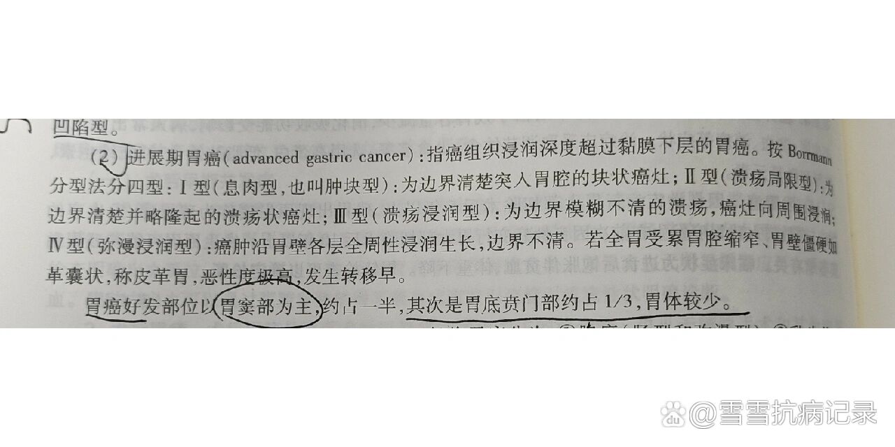 进展期胃癌(advanced