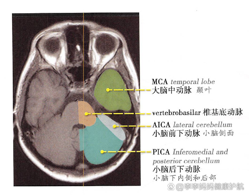 大脑中动脉皮质支图片