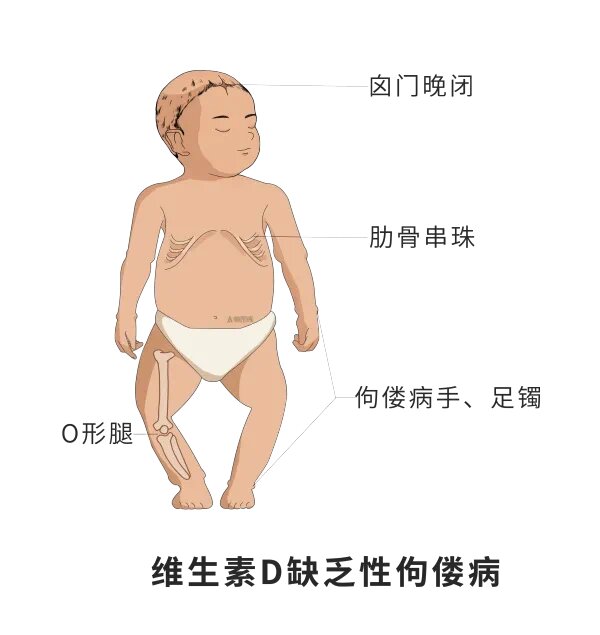 维生素d缺乏常见症状有哪些