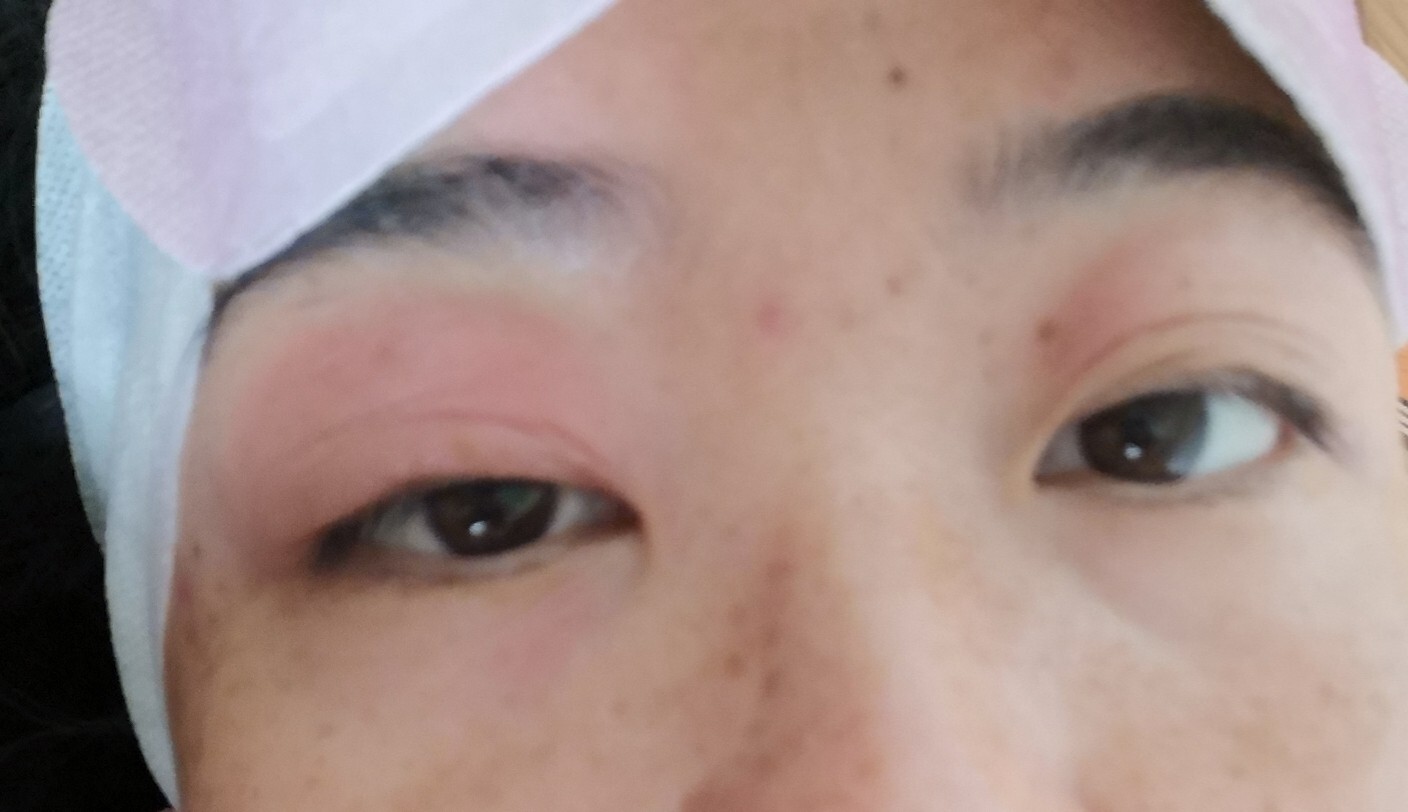 眼皮突然肿,干痒发红,一天时间快速消肿