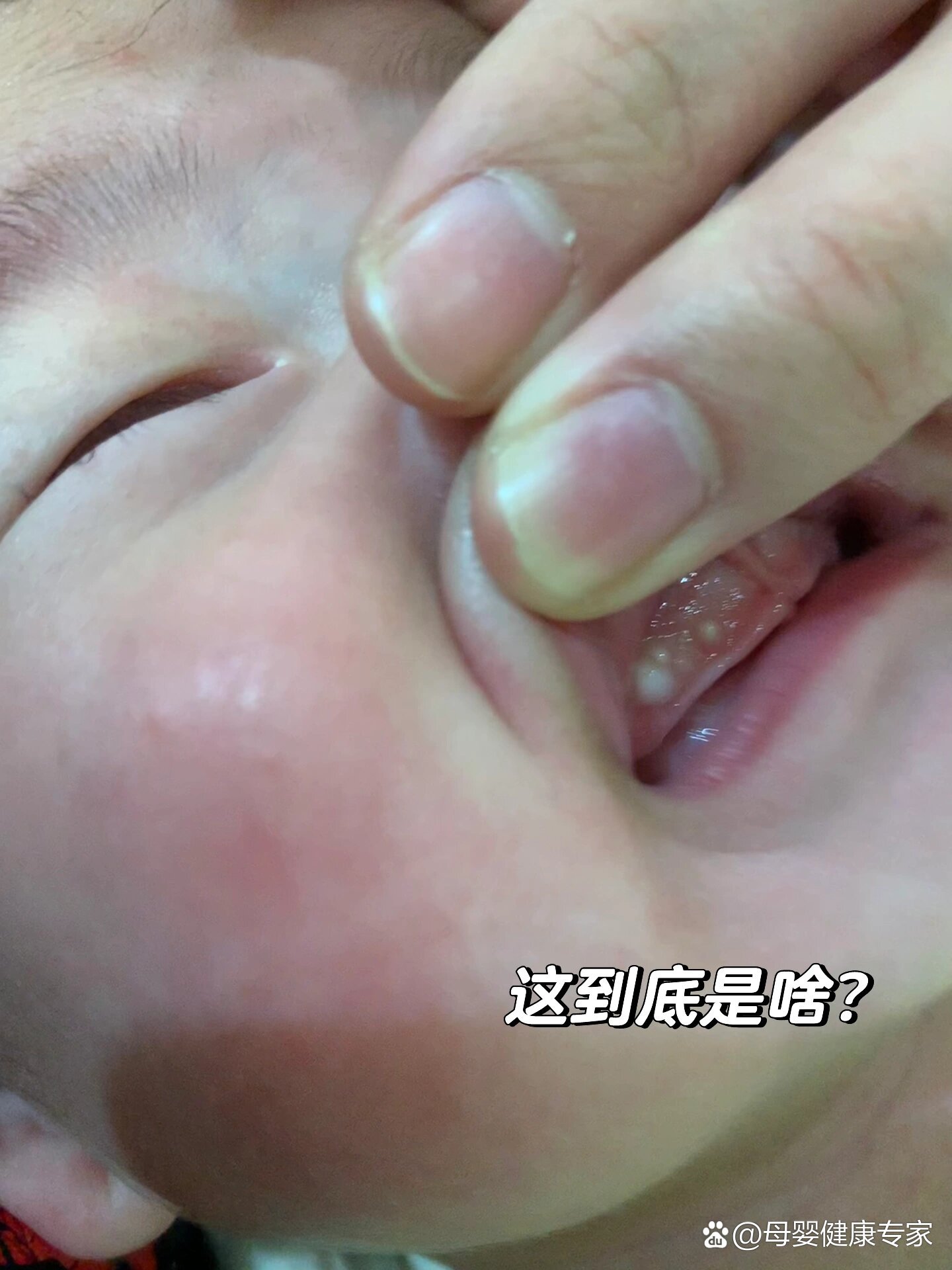 你家宝宝牙龈有这种白点点吗⁉️