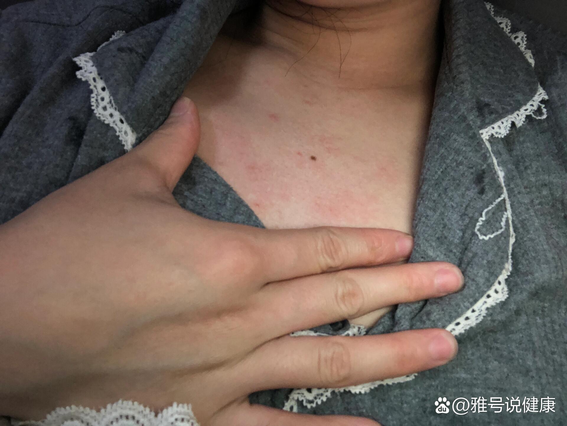 女性胸前长痘痘图片