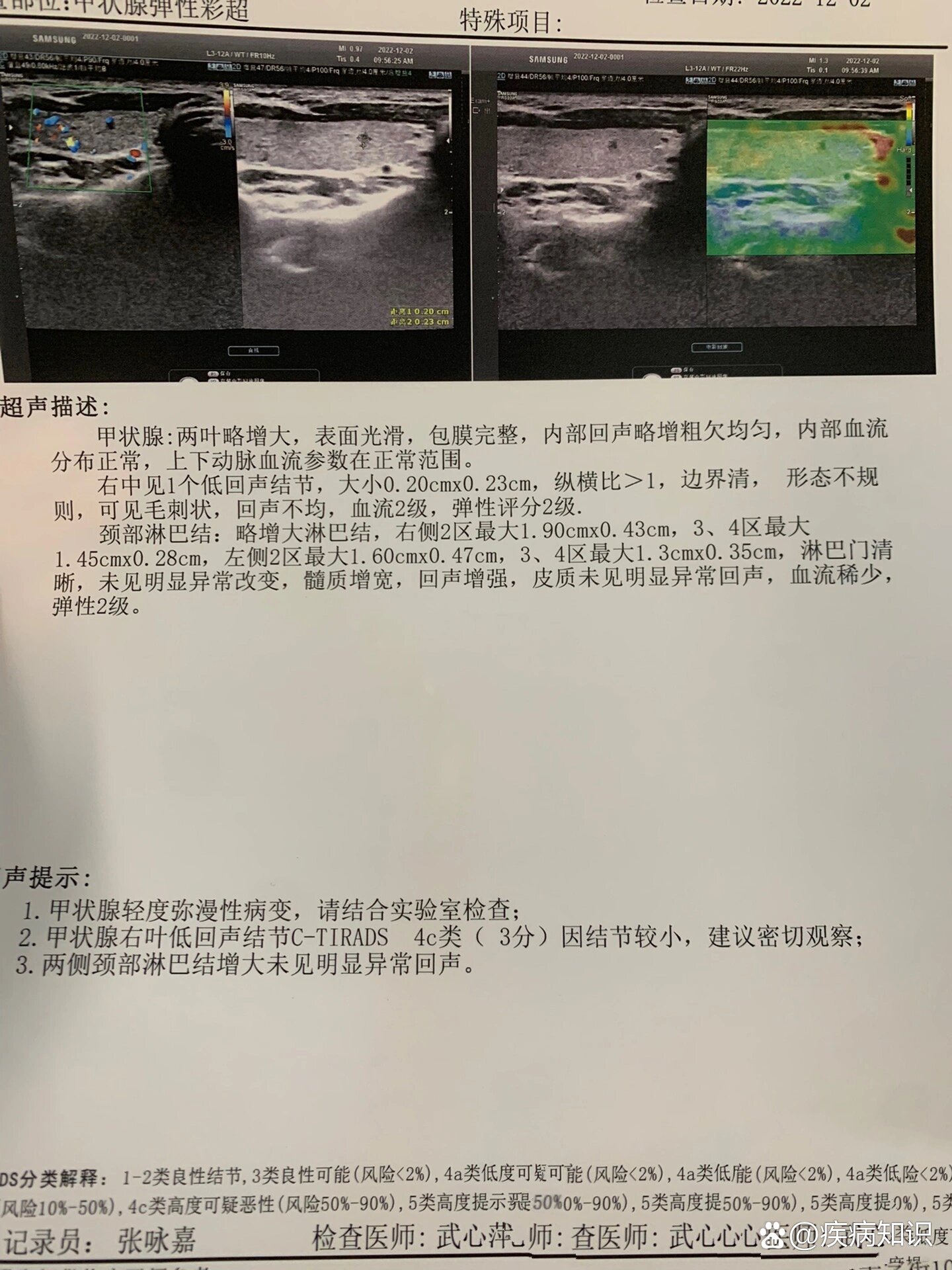 甲状腺癌新的b超