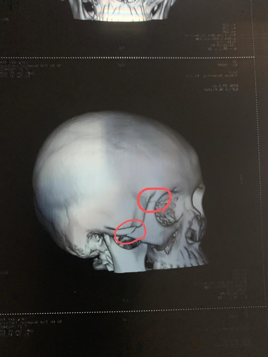 颧弓多发骨折到底要不要手术啊啊
