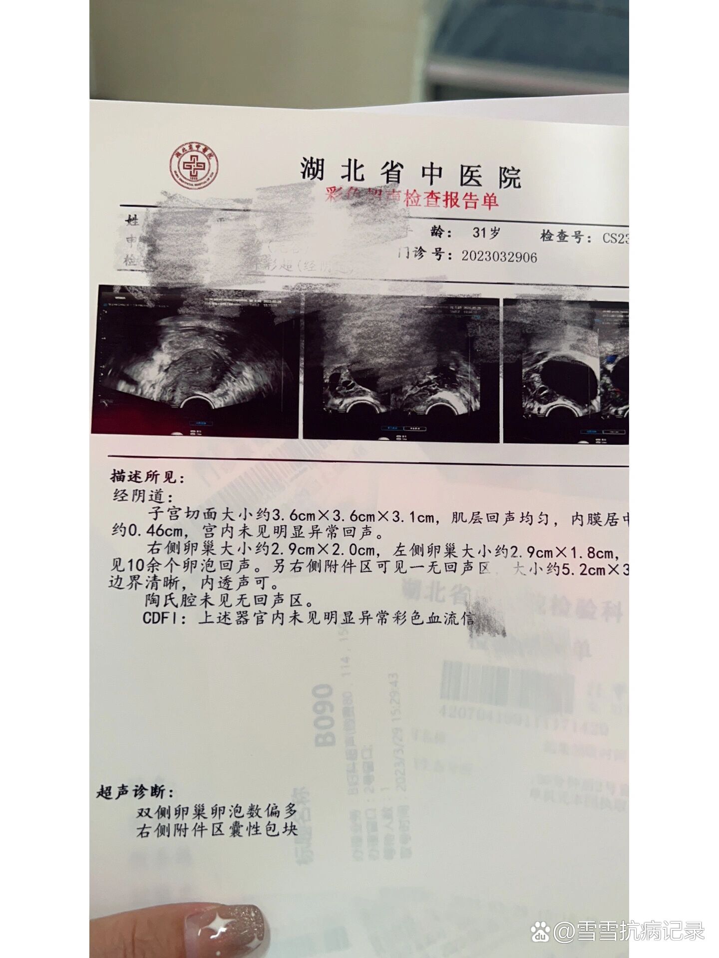 女性腹腔巨大囊性包块图片