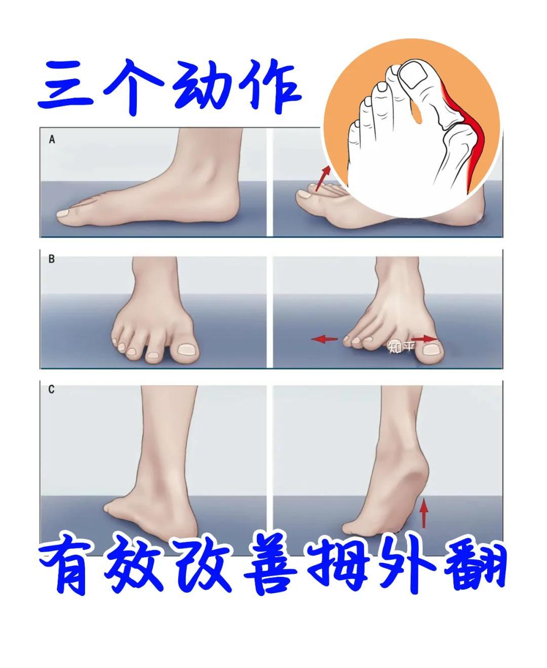拇外翻自救指南👣在家练3招，舒缓疼痛！