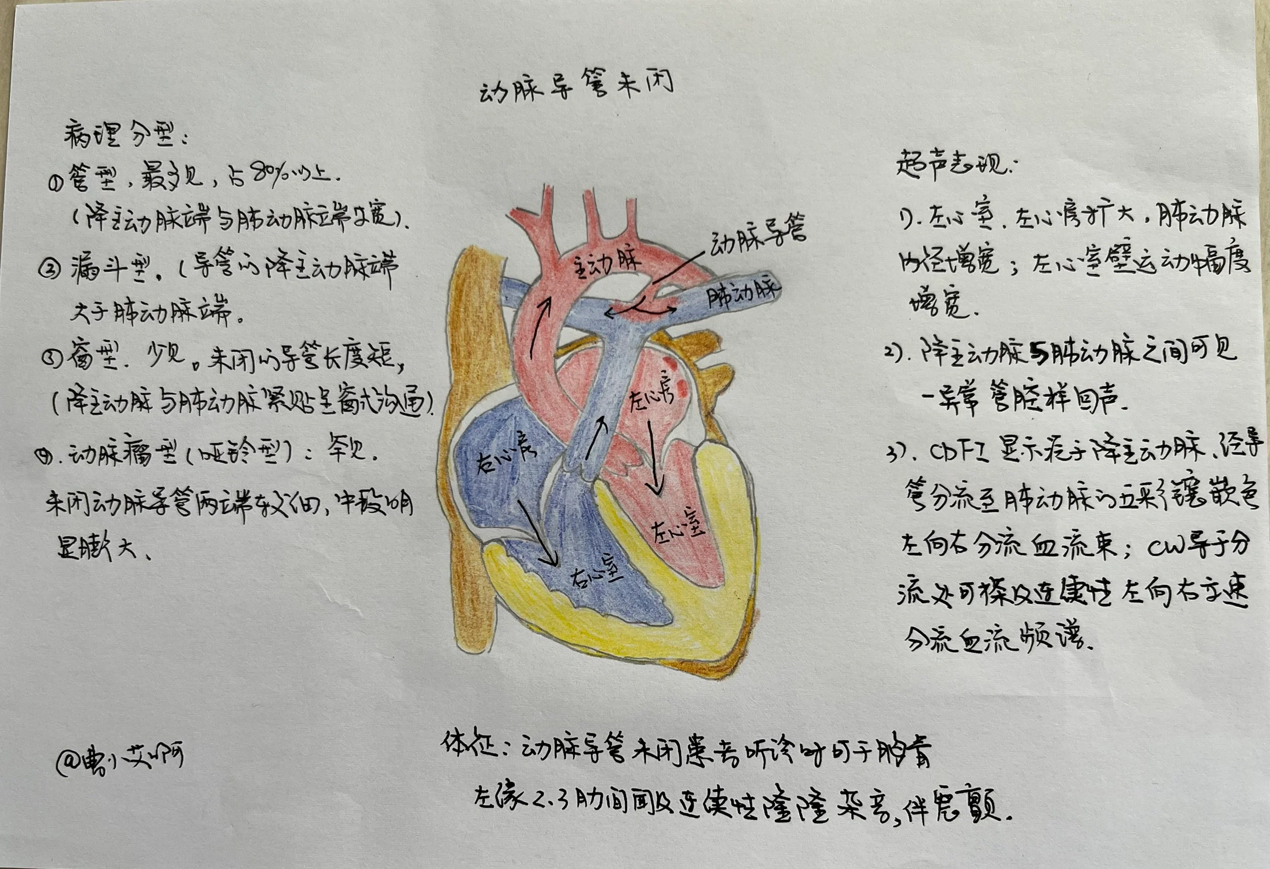 手绘图之动脉导管未闭