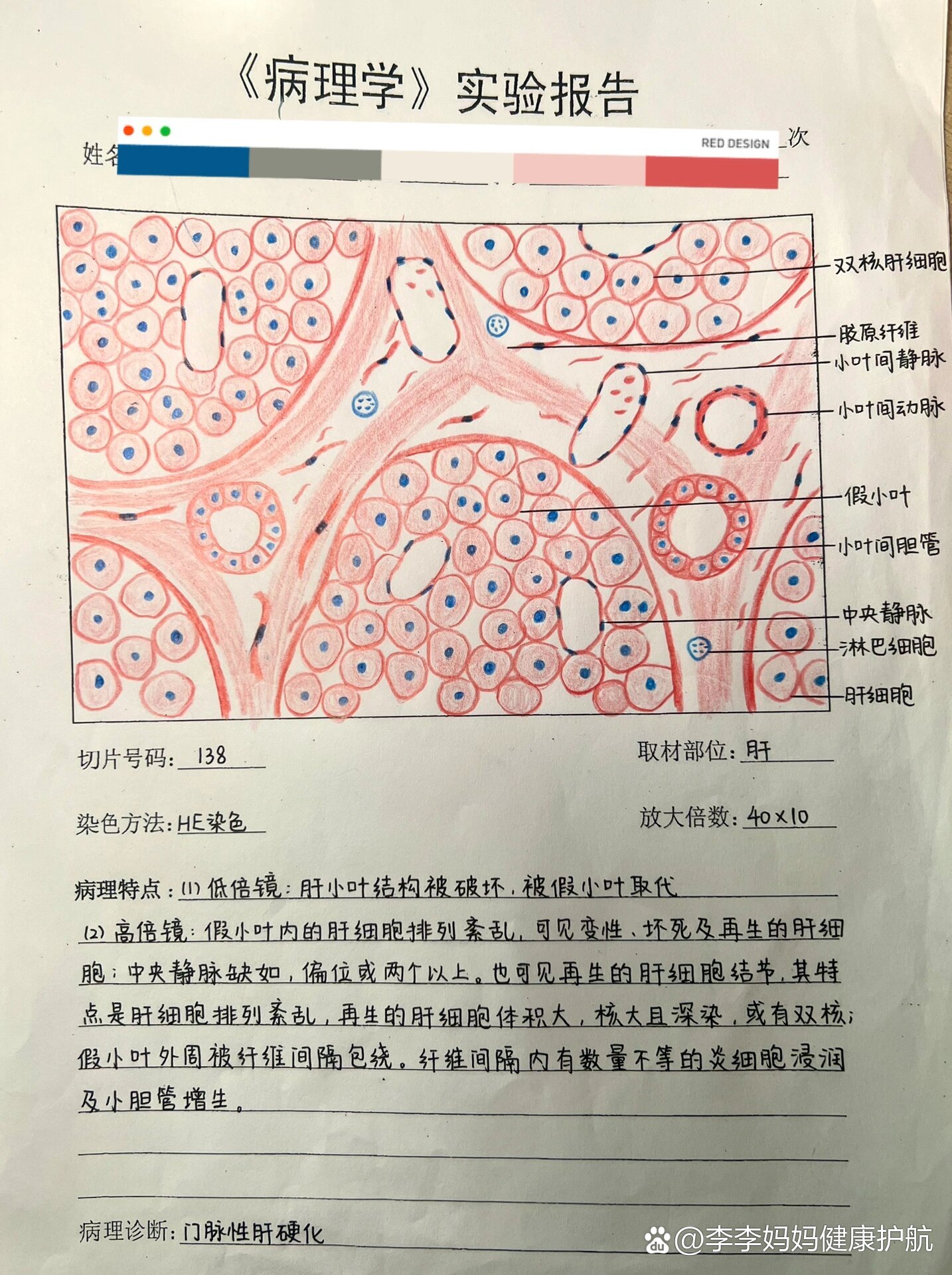 🧠病理学实验报告5⃣️门脉性肝硬化