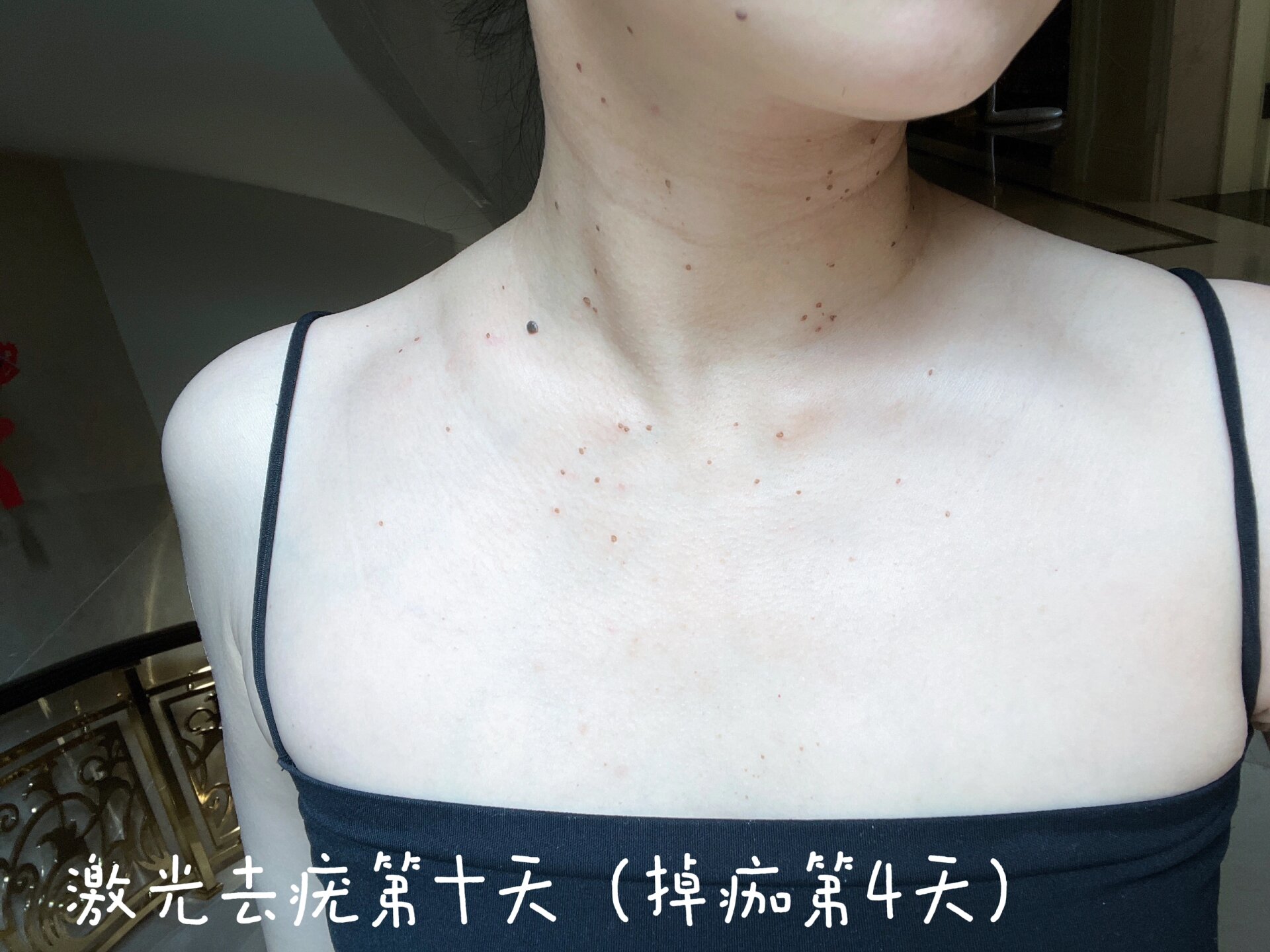 激光去疣第十天(开始掉痂第4天)