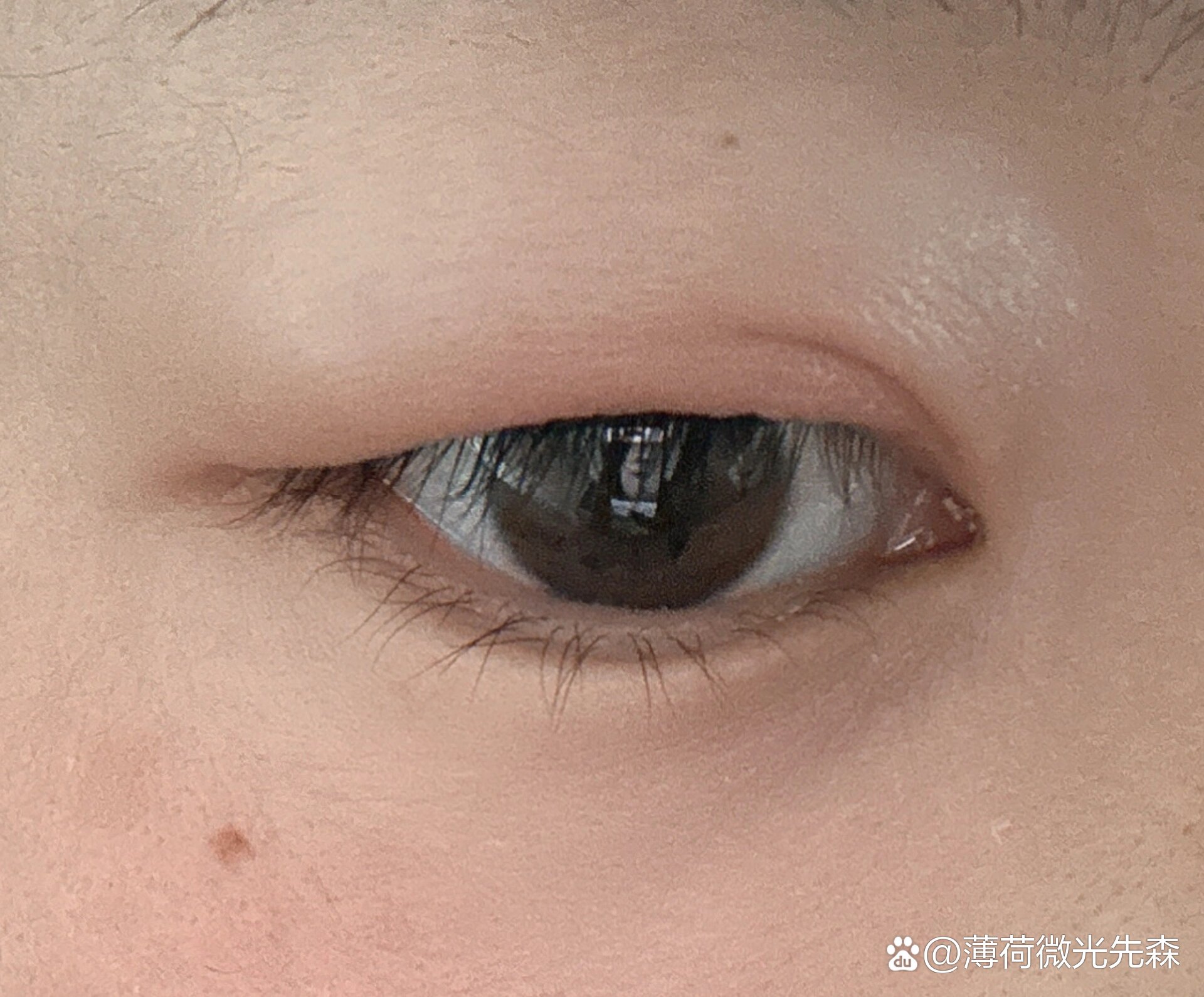  br>我也喜提上眼皮肿痛 br>去医院检查是睑腺炎… br>医生开的药和