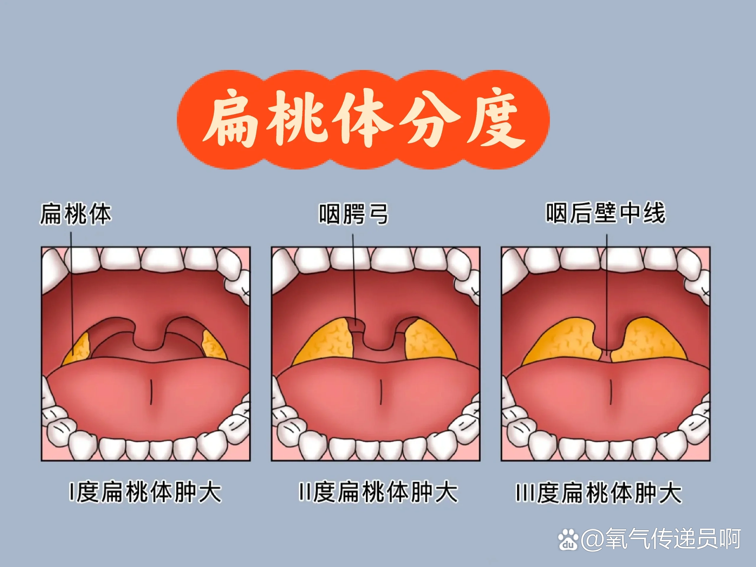 咽部和扁桃体位置图片图片