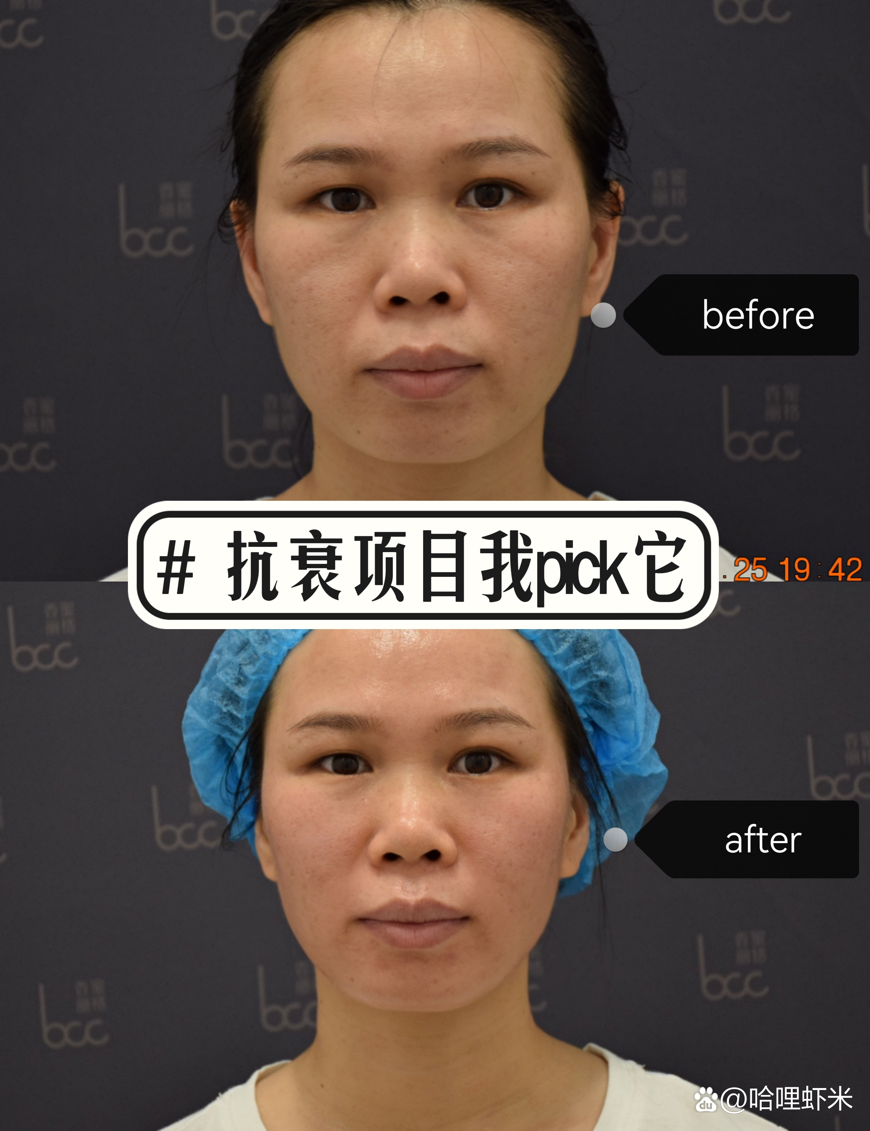 抗衰项目我pick它