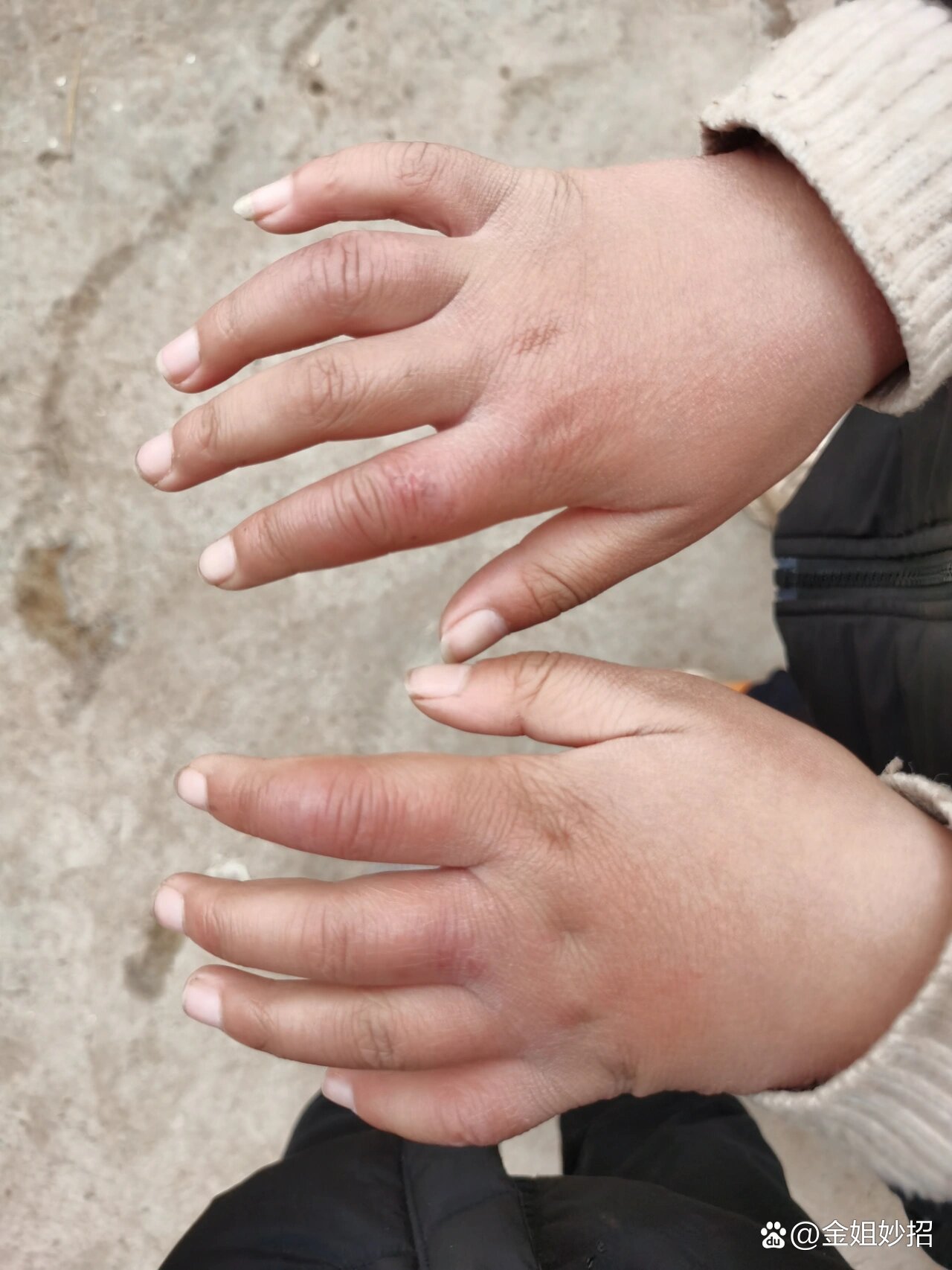 柚子皮治疗冻疮:超级有效