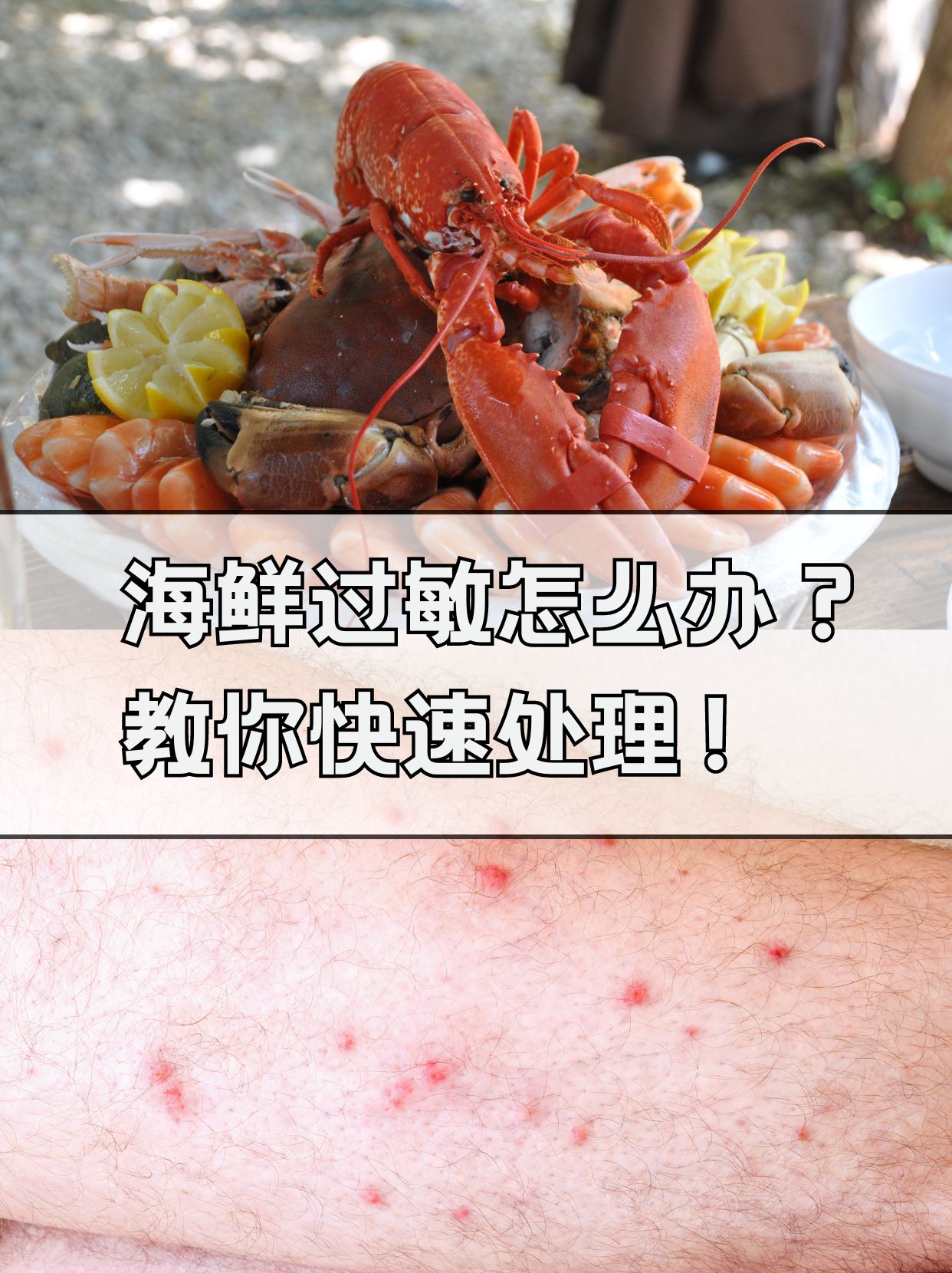 海鲜过敏怎么办?教你快速处理!