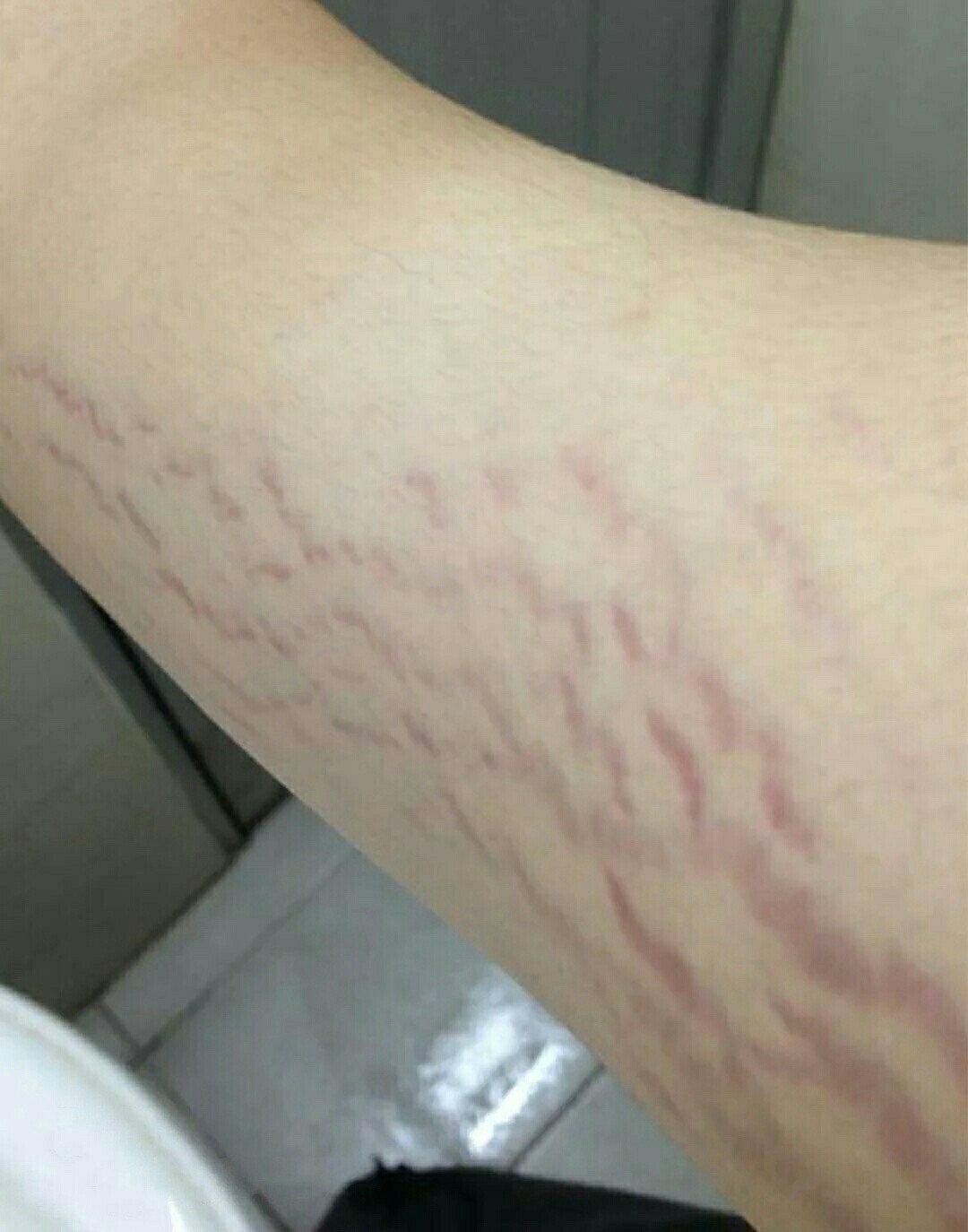 我胳膊上长肥胖纹啦!