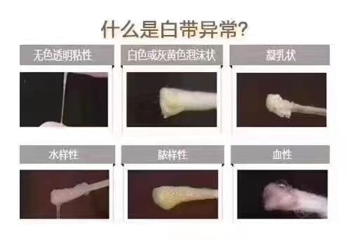 晋中白带异常